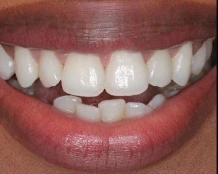 Anti Aging Dentofacial Lift 1 Before - Cosmetic Dental Studios NYC