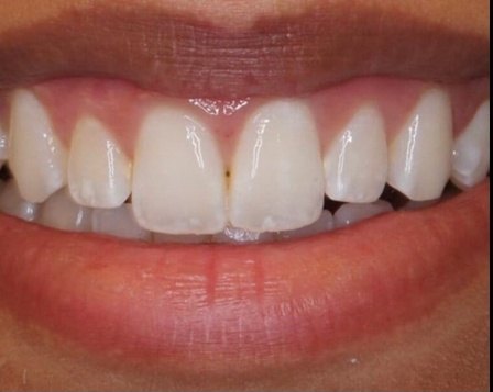 Anti Aging Dentofacial Lift 2 Before - Cosmetic Dental Studios NYC