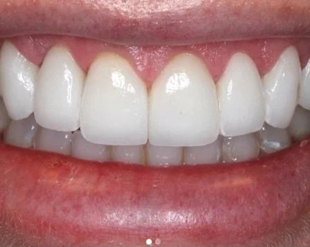 Anti Aging Dentofacial Lift 3 After - Cosmetic Dental Studios NYC