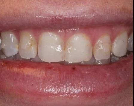 Anti Aging Dentofacial Lift 3 Before - Cosmetic Dental Studios NYC