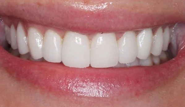 Anti Aging Dentofacial Lift 4 After - Cosmetic Dental Studios NYC