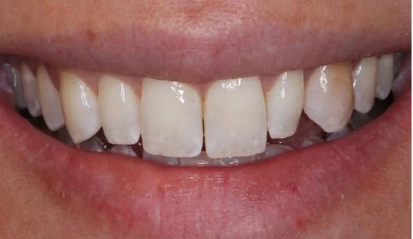 Anti Aging Dentofacial Lift 4 Before - Cosmetic Dental Studios NYC