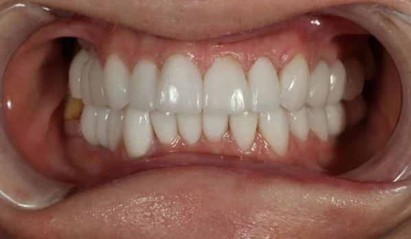 Anti Aging Dentofacial Lift 5 After - Cosmetic Dental Studios NYC