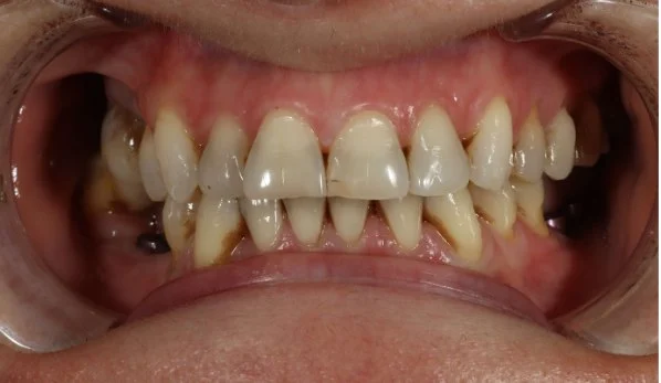 Anti Aging Dentofacial Lift 5 Before - Cosmetic Dental Studios NYC