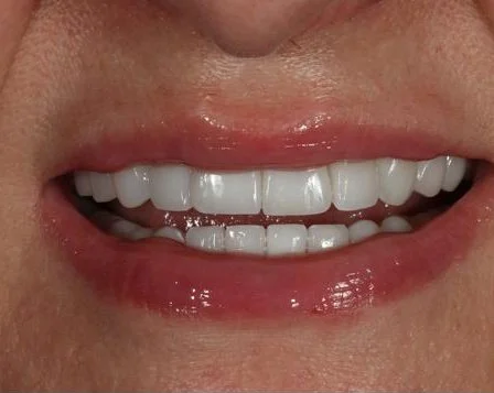 Anti Aging Dentofacial Lift 6 After - Cosmetic Dental Studios NYC