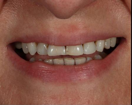 Anti Aging Dentofacial Lift 6 Before - Cosmetic Dental Studios NYC