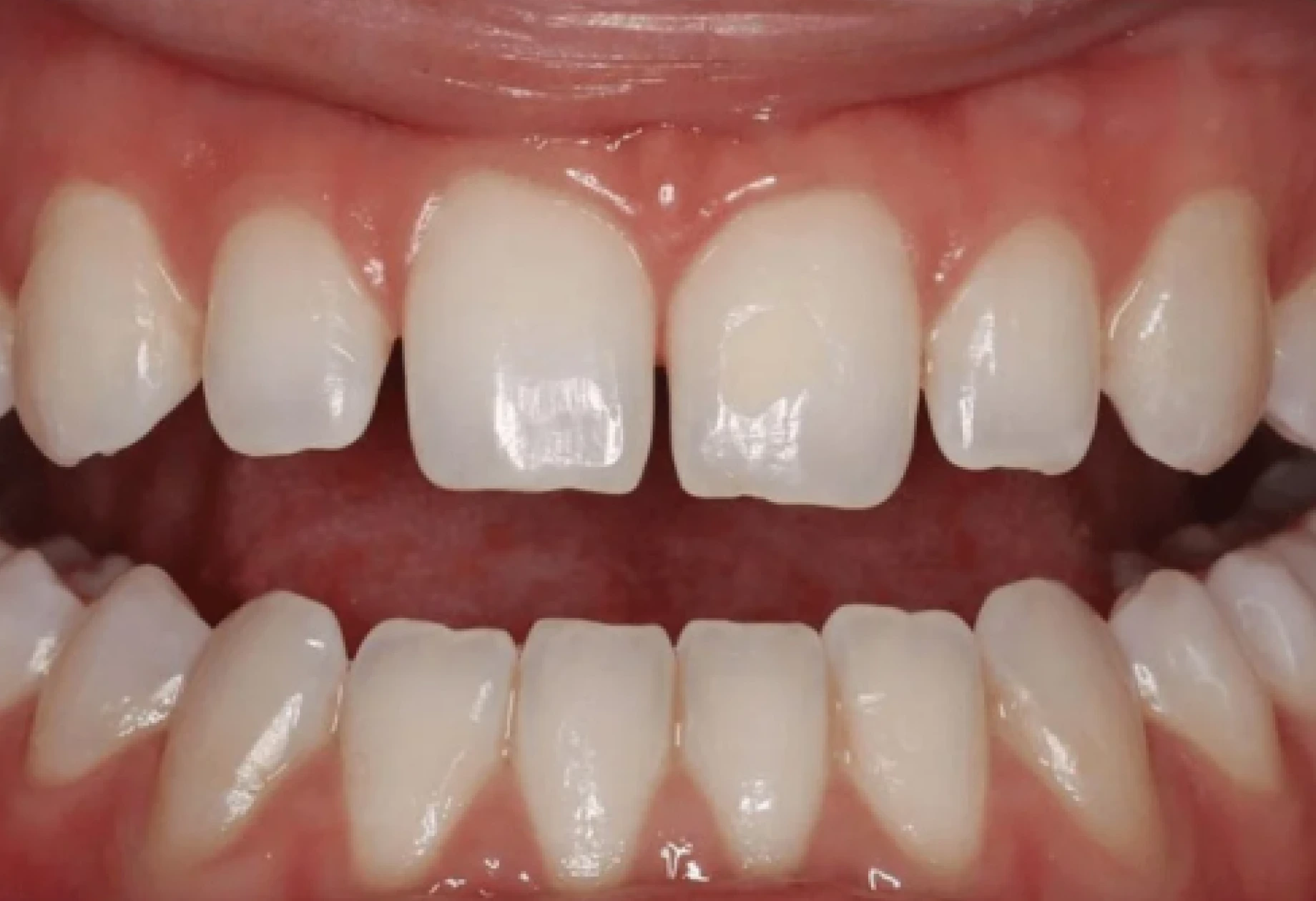 Patient's upper and lower front teeth before porcelain veneers treatment