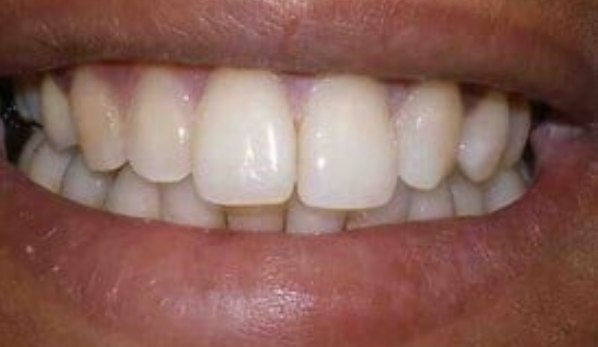 Dental Bonding Contouring 1 After - Cosmetic Dental Studios NYC