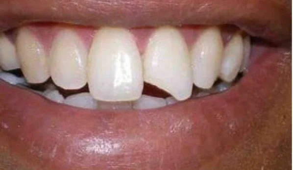 Dental Bonding Contouring 1 Before - Cosmetic Dental Studios NYC
