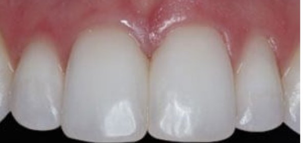 Dental Bonding Contouring 2 After - Cosmetic Dental Studios NYC