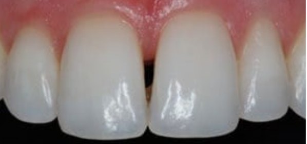 Dental Bonding Contouring 2 Before - Cosmetic Dental Studios NYC