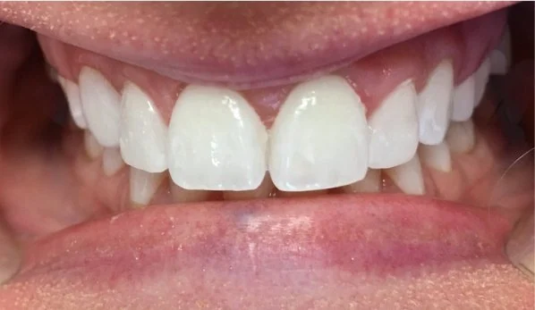 Dental Bonding Contouring 3 After - Cosmetic Dental Studios NYC