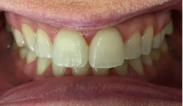Dental Bonding Contouring 3 Before - Cosmetic Dental Studios NYC