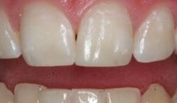 Dental Bonding Contouring 4 After - Cosmetic Dental Studios NYC
