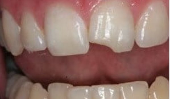 Dental Bonding Contouring 4 Before - Cosmetic Dental Studios NYC