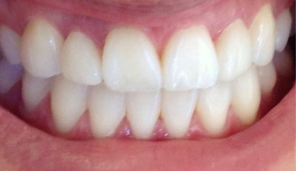 Dental Bonding Contouring 5 After - Cosmetic Dental Studios NYC