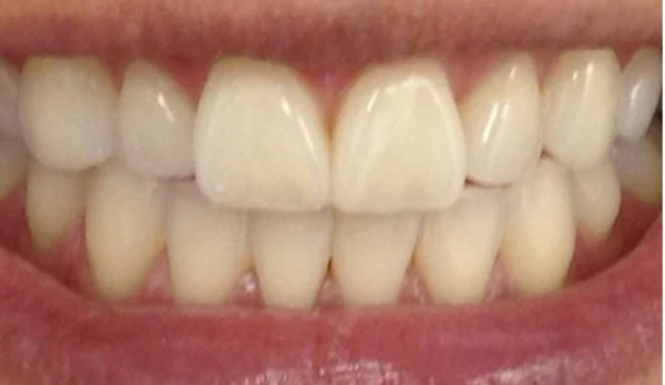 Dental Bonding Contouring 5 Before - Cosmetic Dental Studios NYC