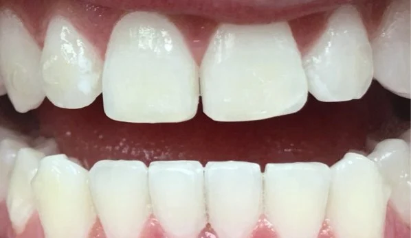 Dental Bonding Contouring 6 After - Cosmetic Dental Studios NYC