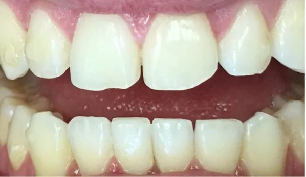 Dental Bonding Contouring 6 Before - Cosmetic Dental Studios NYC