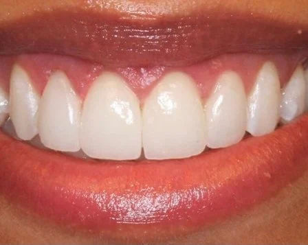 Minimal Prep Veneers 2 After - Cosmetic Dental Studios NYC