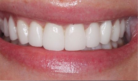 Minimal Prep Veneers 3 After - Cosmetic Dental Studios NYC
