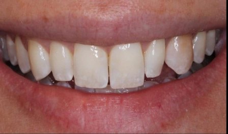 Minimal Prep Veneers 3 Before - Cosmetic Dental Studios NYC