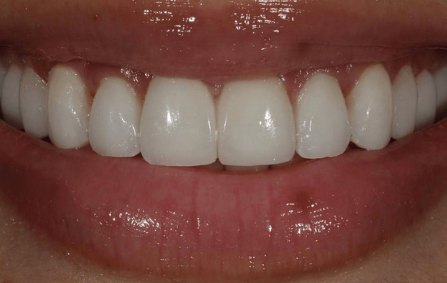 Minimal Prep Veneers 4 After - Cosmetic Dental Studios NYC