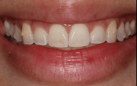 Minimal Prep Veneers 4 Before - Cosmetic Dental Studios NYC