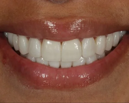 Minimal Prep Veneers 5 After - Cosmetic Dental Studios NYC
