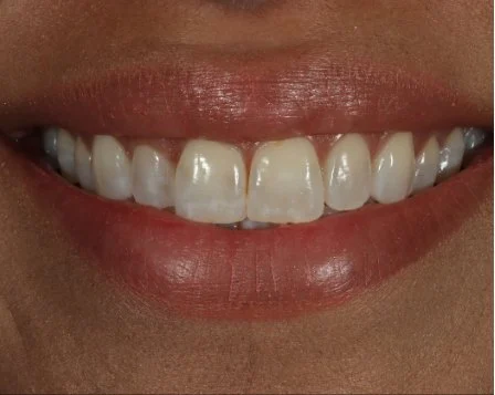 Minimal Prep Veneers 5 Before - Cosmetic Dental Studios NYC