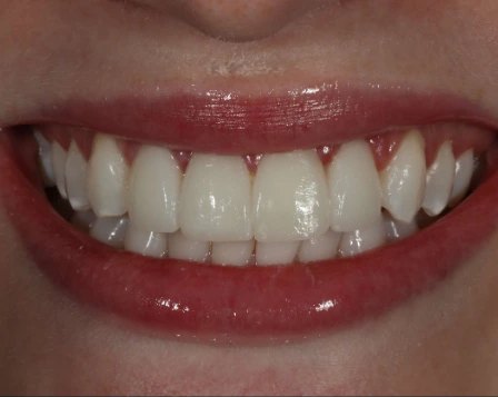 Minimal Prep Veneers 6 After - Cosmetic Dental Studios NYC