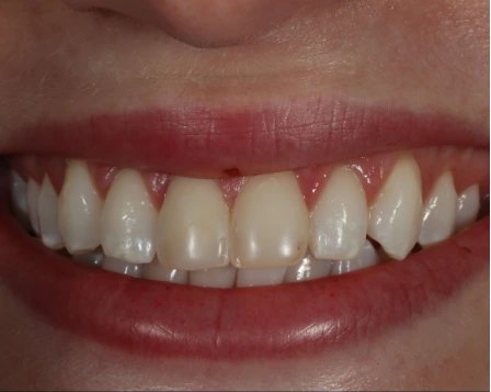 Minimal Prep Veneers 6 Before - Cosmetic Dental Studios NYC