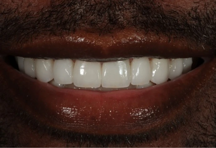 Patient's smile showing natural teeth before porcelain veneers treatment