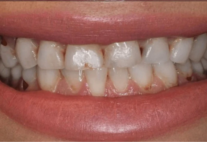Before porcelain veneers: patient's upper teeth showing discoloration and uneven spacing
