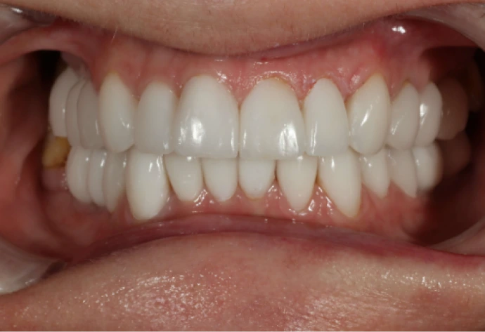 Patient's smile before porcelain veneers treatment, showing uneven tooth spacing and discoloration