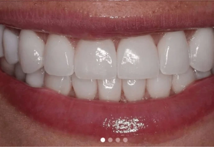 Before porcelain veneers: close-up of upper and lower teeth with uneven spacing and discoloration