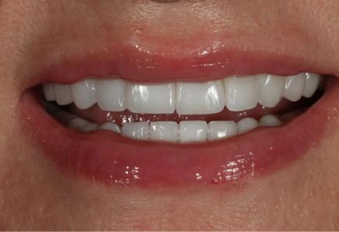 Patient's smile showing teeth with uneven spacing before porcelain veneers treatment