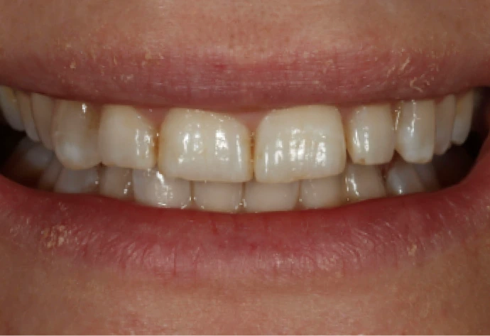 Before porcelain veneers: patient's upper front teeth showing discoloration and uneven spacing