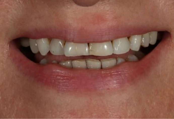 Patient's smile before porcelain veneers, showing uneven and discolored teeth
