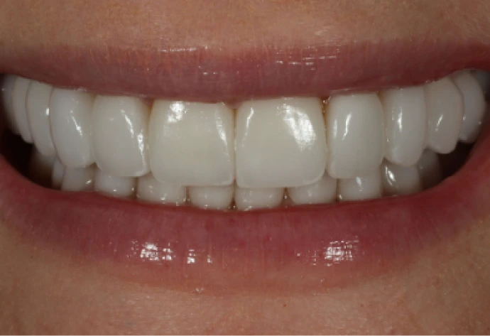 Patient's smile showing uneven, discolored teeth before porcelain veneers treatment