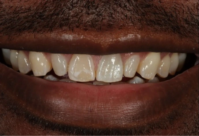 Patient's smile before porcelain veneers, showing discolored and uneven front teeth
