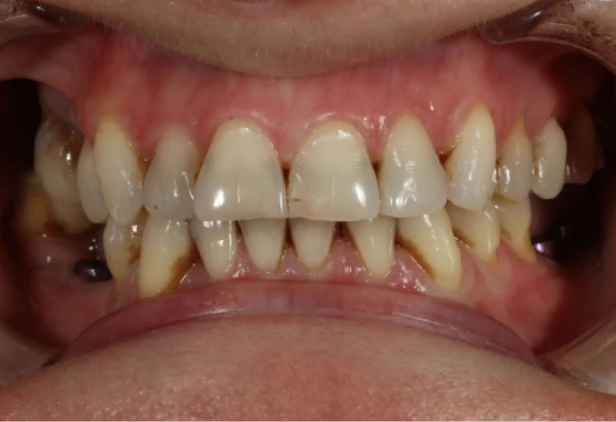 Patient's teeth before porcelain veneers, showing discoloration and uneven spacing