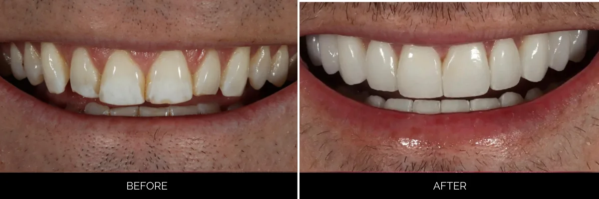 Before and after smile transformation showing improved tooth shape and whiteness