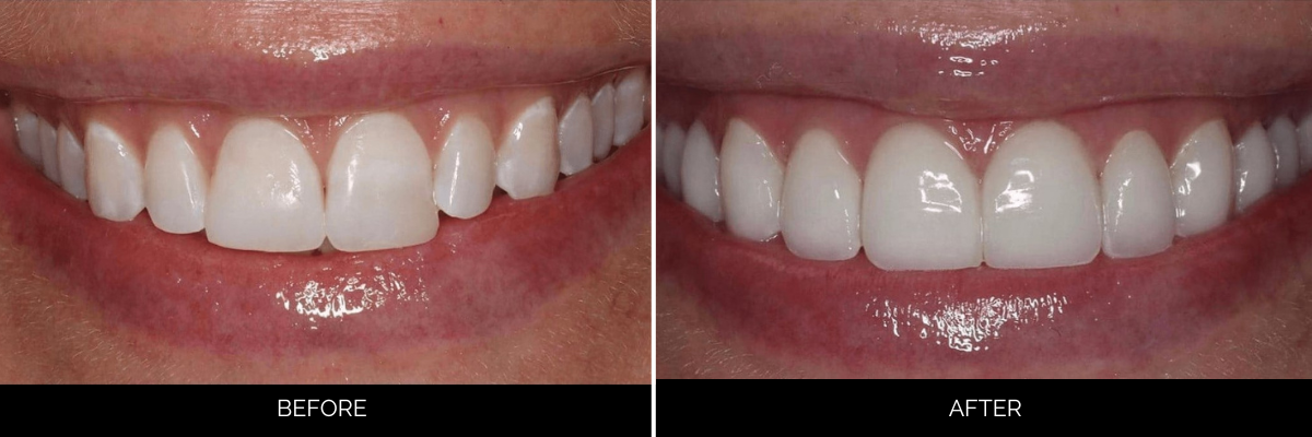 Before and after smile showing improved tooth color, shape, and symmetry