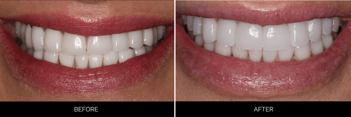 Before and after smile showing enhanced tooth alignment and brightness