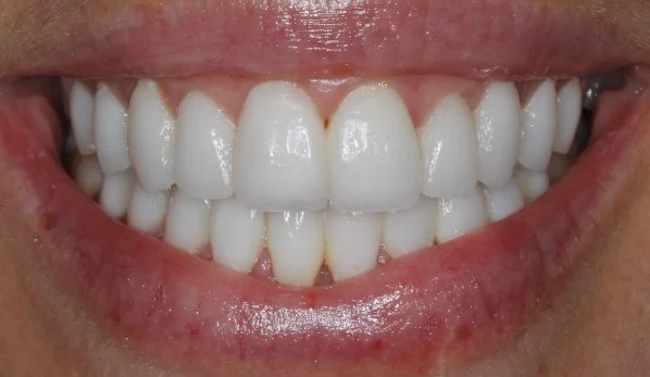 Smile Design 1 After - Cosmetic Dental Studios NYC