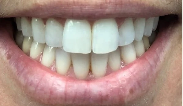 Smile Design 1 Before - Cosmetic Dental Studios NYC