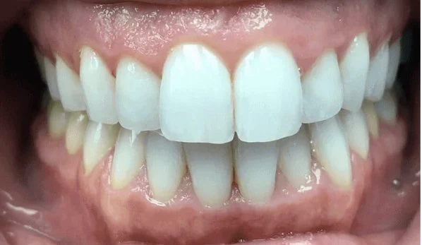 Smile Design 2 Before - Cosmetic Dental Studios NYC