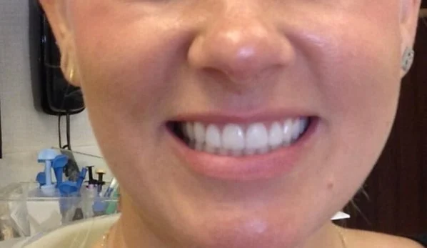 Smile Design 3 After - Cosmetic Dental Studios NYC