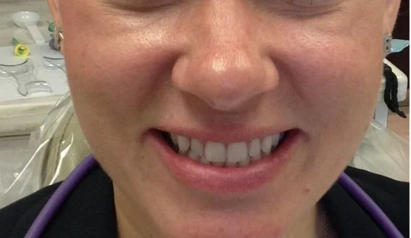 Smile Design 3 Before - Cosmetic Dental Studios NYC